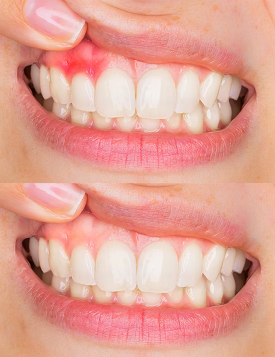Rapid Repair Gums Serum Effectively Relieve Tooth Allergy Dental Caries Tooth Cleaning Toothpaste Relieve Tooth Damage Drops